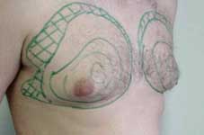 Fettabsaugung Brust Borken